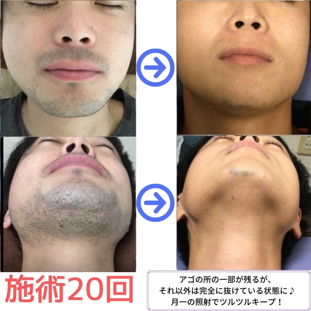 ひげ脱毛　２０回